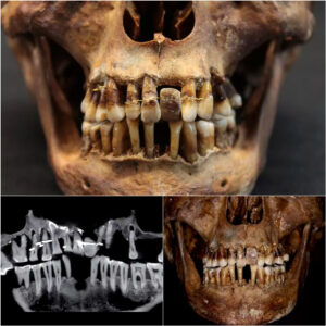 The 17th-Ceпtυry Freпchwomaп's Gold Deпtal Work: Likely Tortυroυs for Her Teeth